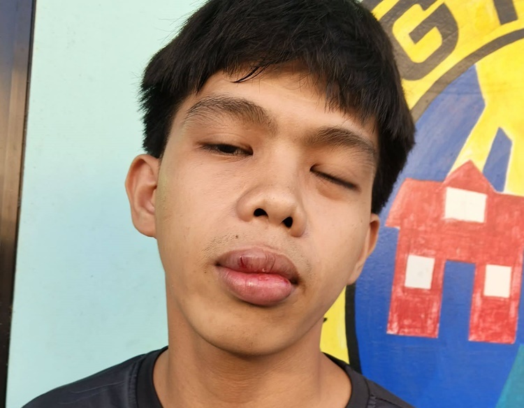 Lady Netizen Shares Brother’s Suffering After Being Beaten by Several Men