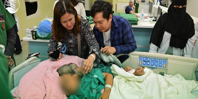 フィリピン結合双生児、18時間手術で別々の人生へ