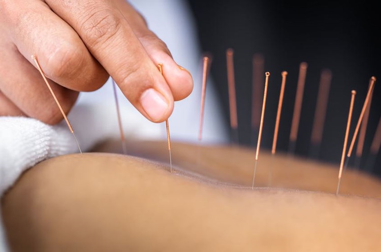 Acupuncture session2